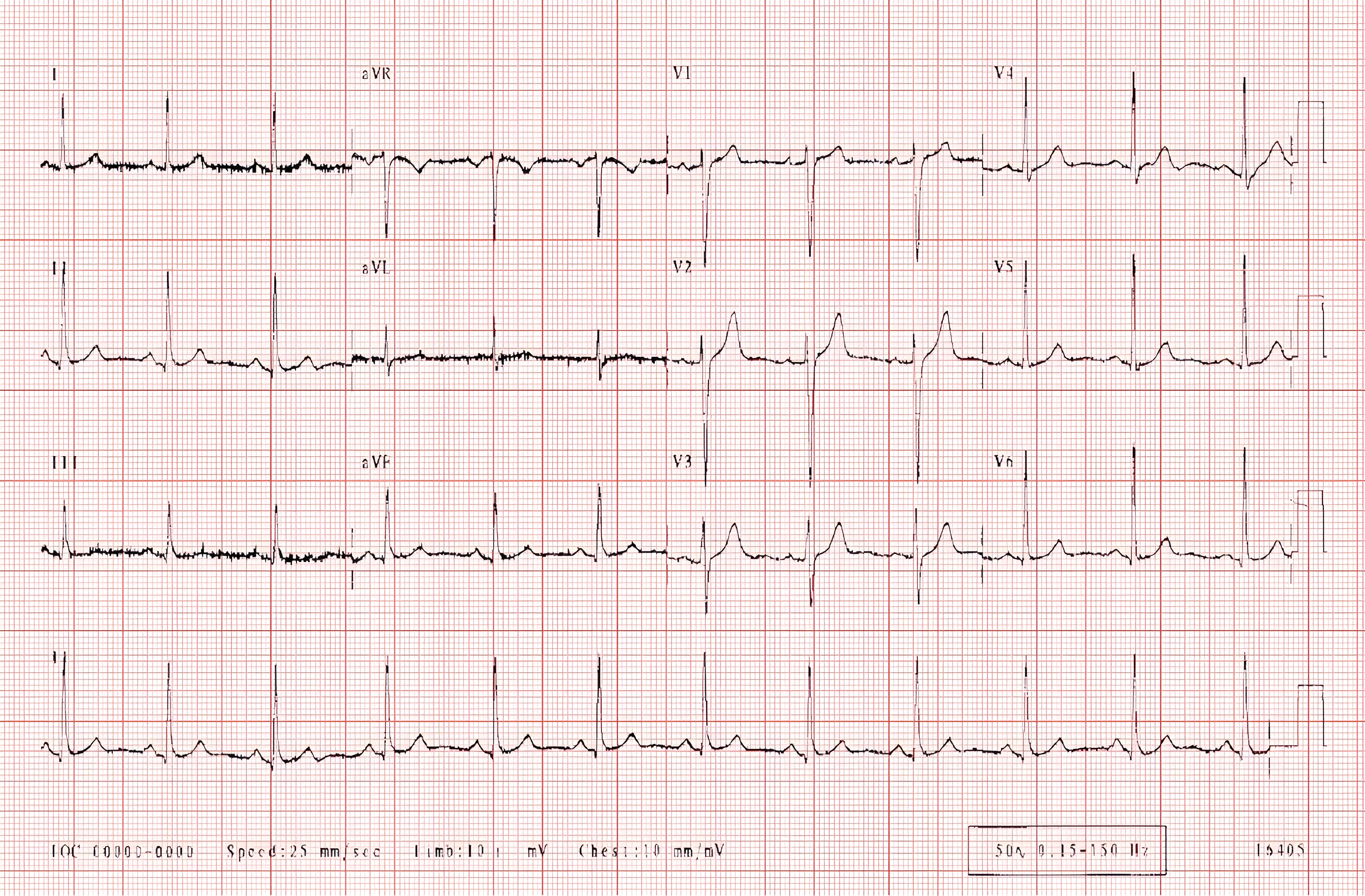 Hasil pemeriksaan EKG
